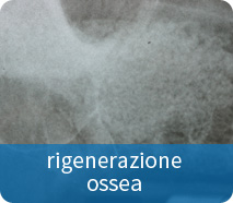invisalign