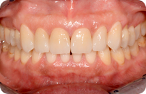 applicazione faccette e corone ceramica integrale